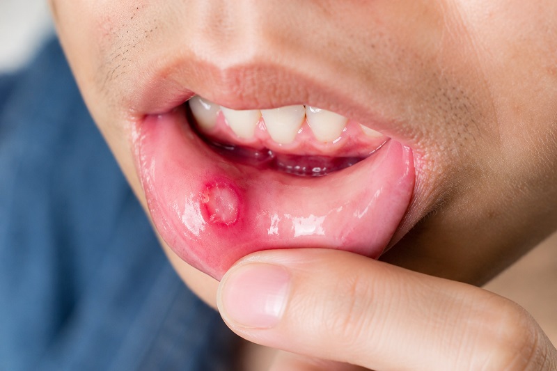 Nhiệt miệng khiến niêm mạc miệng tổn thương và tăng nguy cơ xâm nhập của virus, vi khuẩn khi oral sex. 