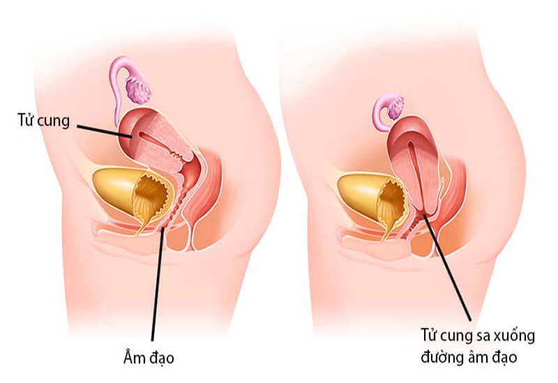 Nhận biết và điều trị bị sa tử cung một cách hiệu quả