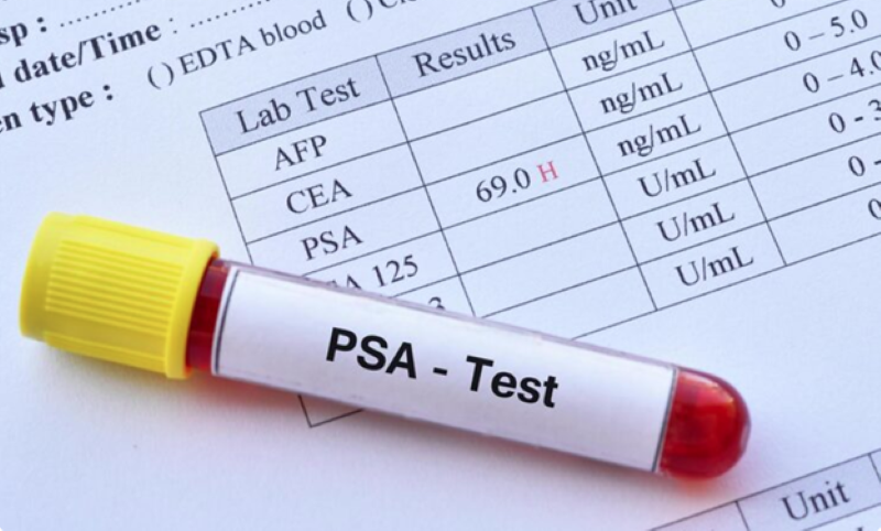 Xét nghiệm PSA có đóng góp trong quá trình chẩn đoán ung thư tuyến tiền liệt