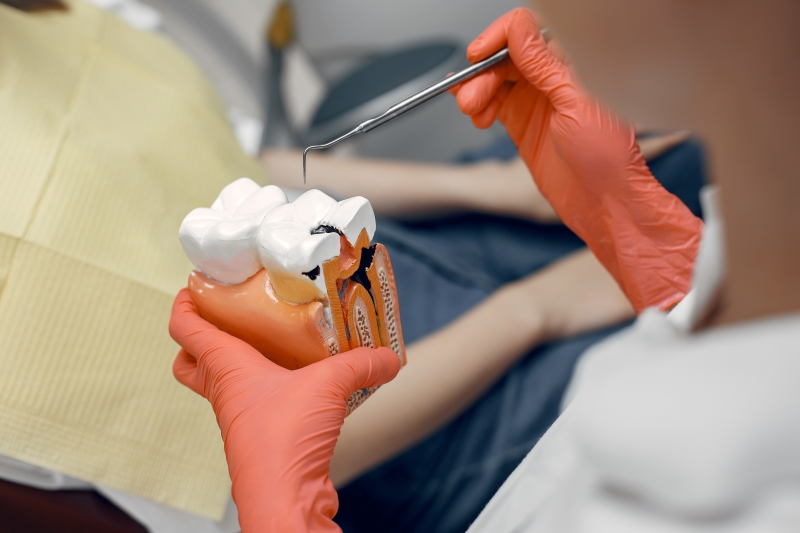 Vật liệu là một trong những yếu tố quyết định trám răng bao nhiêu tiền