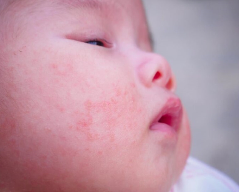 Các nốt mụn gạo ở trẻ em thường nhỏ li ti, màu trắng ngà và tập trung nhiều ở vùng mặt