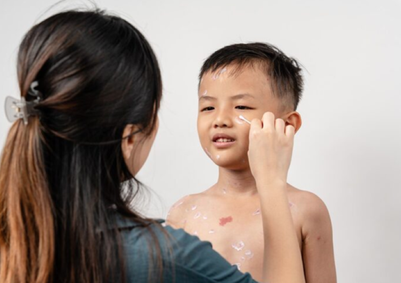 Cha mẹ không nên tự ý sử dụng các loại kem đặc trị của người lớn để xử lý tình trạng mụn gạo ở trẻ em 