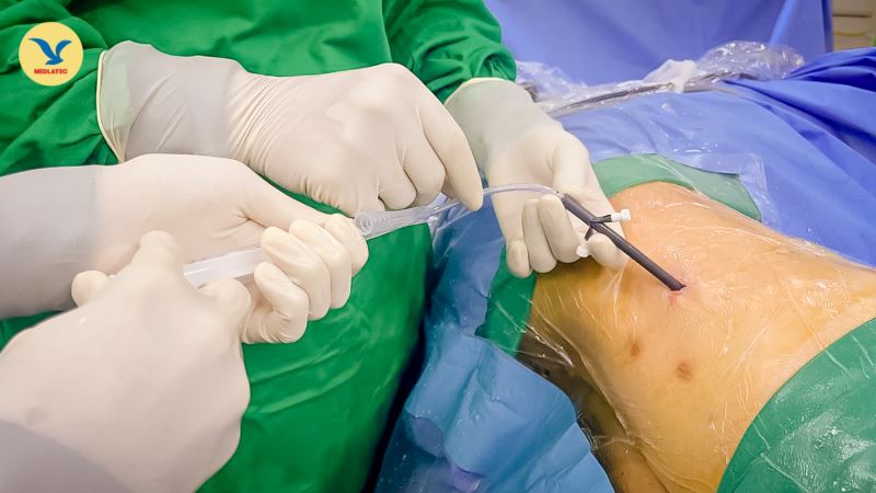 Phương pháp tán sỏi qua da đòi hỏi kỹ thuật cao, áp dụng cho những ca phức tạp, sỏi có kích thước lớn 
