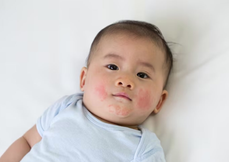 Rôm sảy là bệnh thường gặp ở trẻ nhỏ trong mùa hè