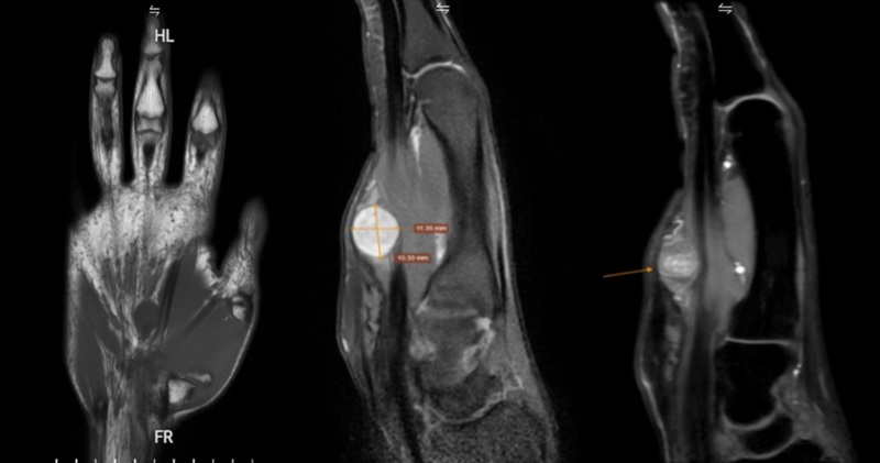 Kết quả chụp MRI ghi nhận có khối dạng bầu dục ở vị trí ống cổ tay