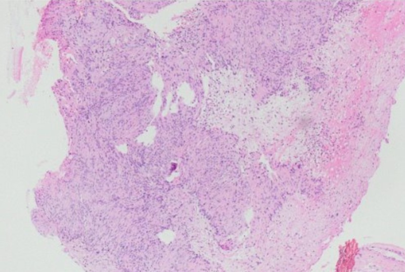 Giải phẫu bệnh cho thấy khối u phù hợp với schwannoma – u bao dây thần kinh