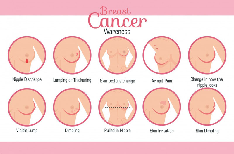U vú ác tính thường có những biểu hiện bất thường đặc trưng