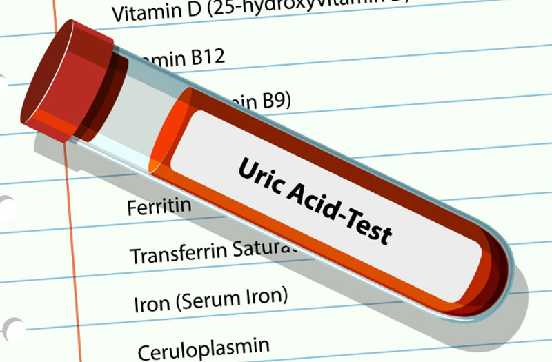 Xét nghiệm acid uric máu là phương pháp đơn giản để phát hiện sớm tình trạng tăng acid uric