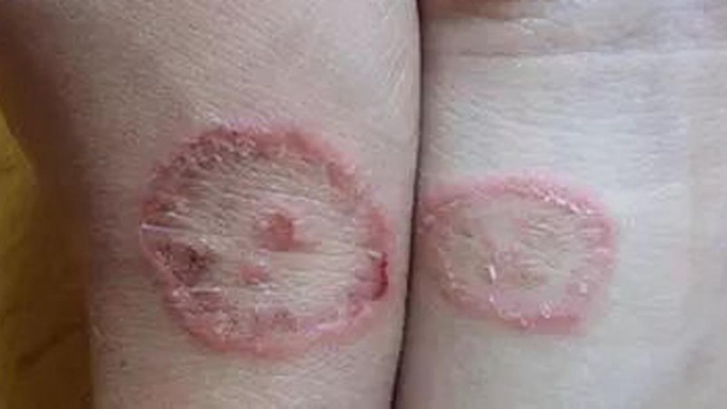 Nấm mèo có biểu hiện khá rõ ràng trên da