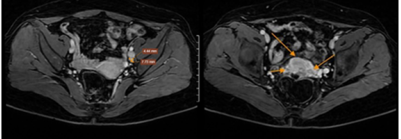 Hình ảnh chụp MRI tiểu khung - vùng chậu của bệnh nhân có phát hiện bất thường