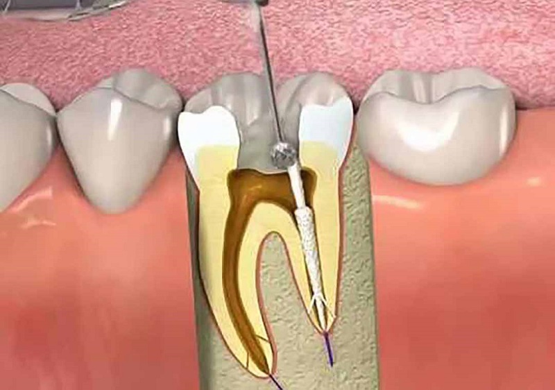 Lấy tủy răng có đau không?
