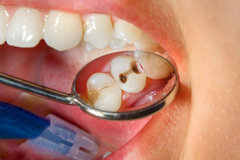 Khi nào cần điều trị tủy răng và một số vấn đề liên quan