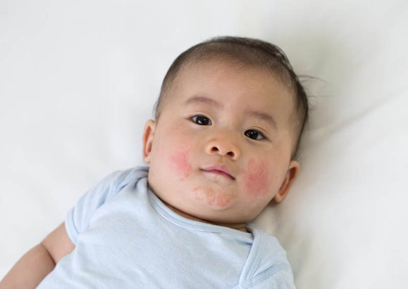 Rôm sảy khiến trẻ sơ sinh xuất hiện các nốt đỏ li ti do tuyến mồ hôi bị bít tắc khi thời tiết nóng ẩm hoặc mặc quá nhiều quần áo