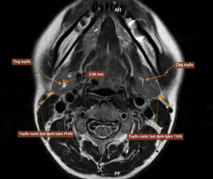 MRI vùng hàm mặt ghi nhận giãn ống tuyến nước bọt dưới hàm phải