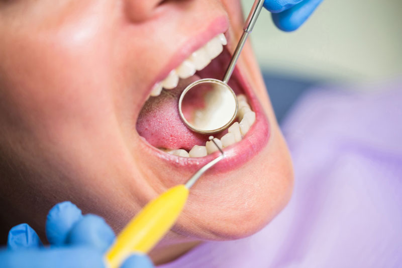 Nhiều người thường thắc mắc trám răng là gì khi đề cập đến phương pháp nha khoa này
