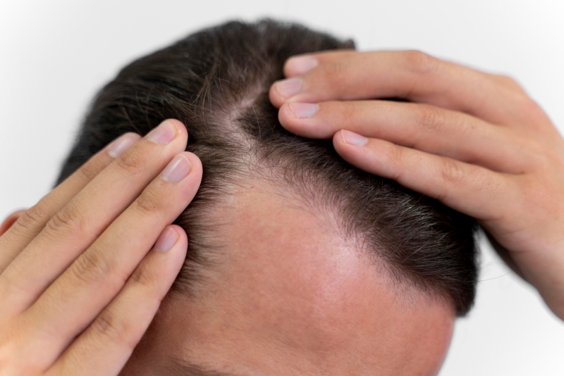Tâm lý căng thẳng là một trong các nguyên nhân dẫn đến tình trạng rụng tóc từng mảng