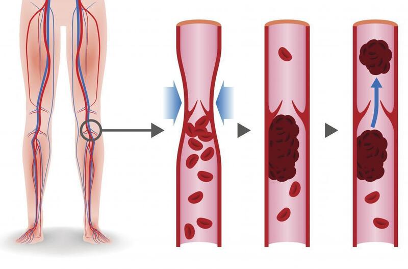 Tại sao viêm mạch máu dẫn đến sưng viêm và hạn chế lưu lượng máu?