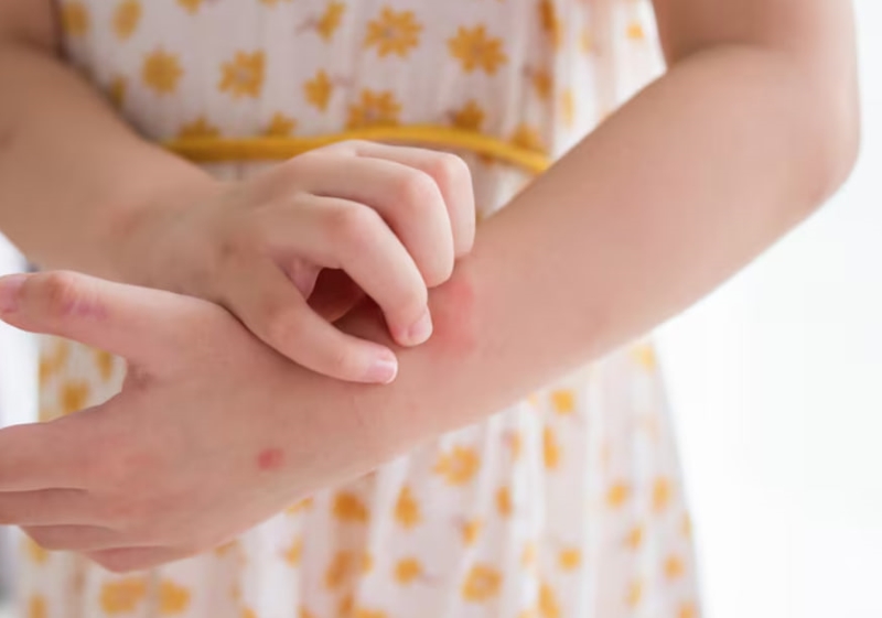 Trẻ bị phỏng dạ nên hạn chế tiếp xúc gần với trẻ khác