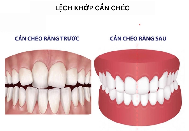 Lệch khớp cắn có nguy cơ gây viêm khớp thái dương hàm