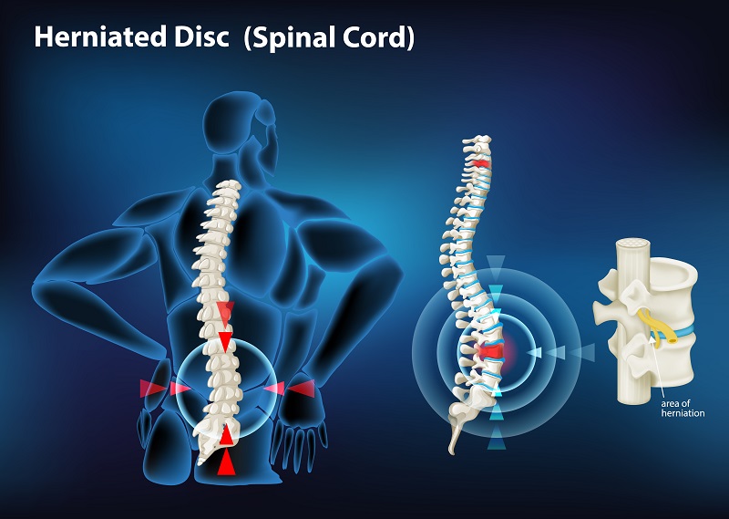 Bị thoát vị đĩa đệm thắt lưng có thể gây đau gần xương cụt