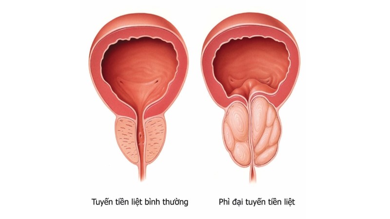 Sự tăng kích thước ở tuyến tiền liệt có liên quan đến tăng sản xuất tuyến tiền liệt không? 
