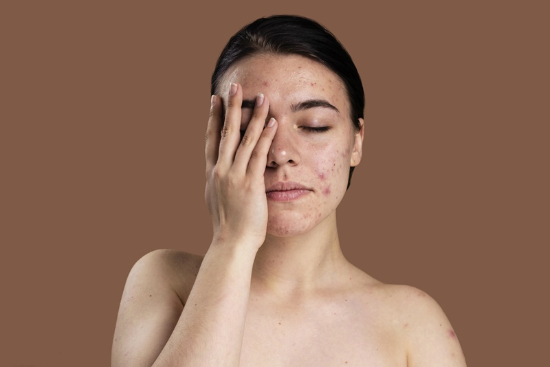 Người có cơ địa da dầu, nhiều mụn không nên bôi Yoosun rau má lên mặt