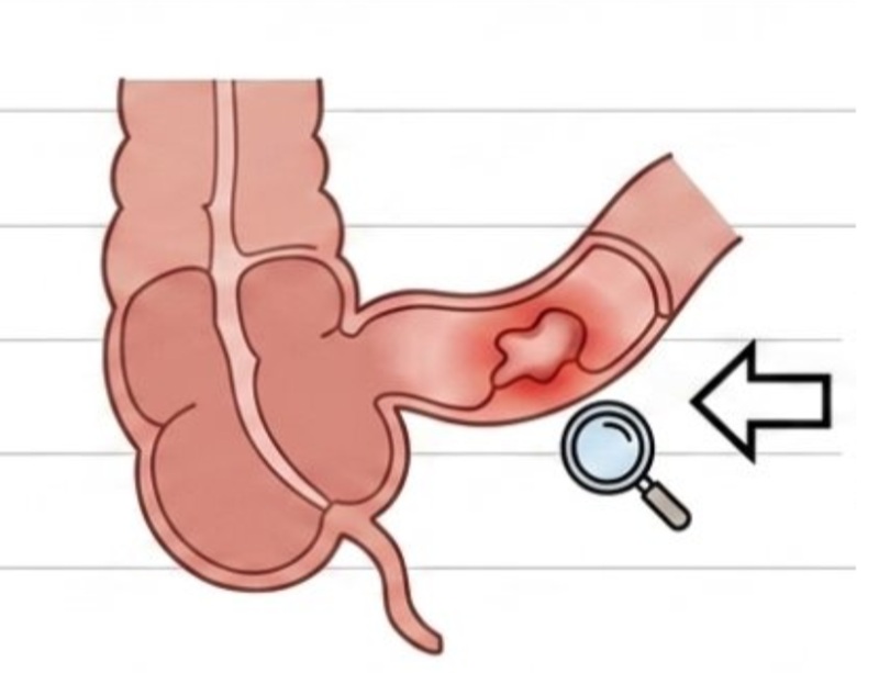 Vị trí thường xuất hiện tổn thương ở đoạn cuối hồi tràng. Ảnh minh họa