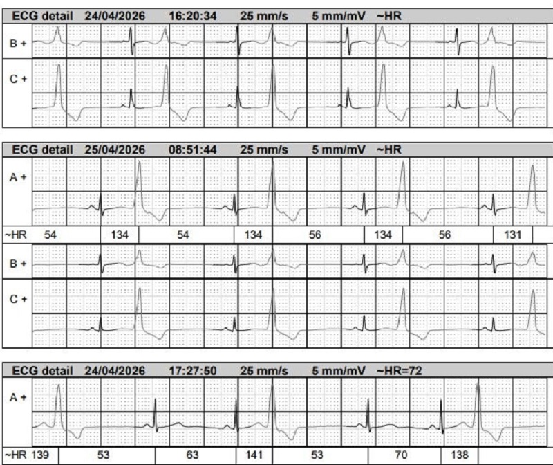 Kết quả Holter điện tim ghi nhận lần ghi thứ nhất ngoại tâm thu thất chiếm 10,1% tổng số nhịp tim