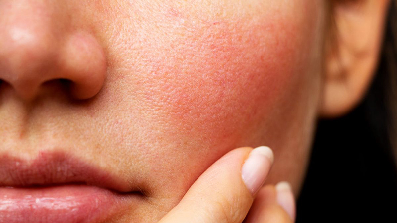 Làm thế nào để phòng tránh da mặt bị khô và ngứa?
