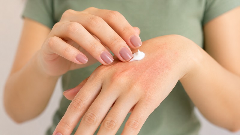 Sử dụng một số thuốc theo chỉ định của bác sĩ giúp giảm nhanh các triệu chứng bệnh viêm da cơ địa.