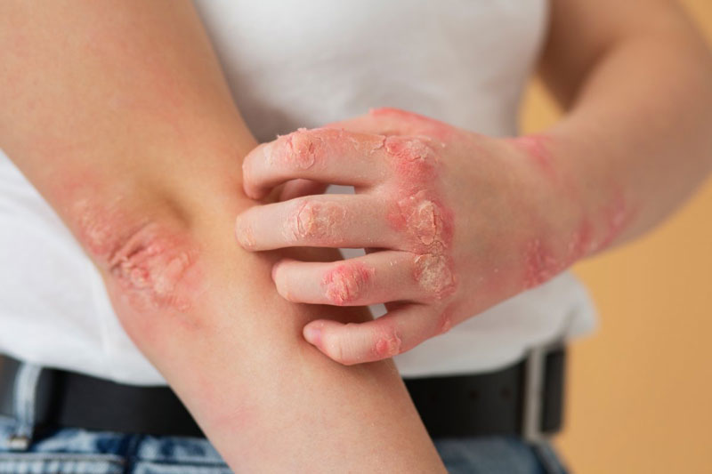 Hình ảnh viêm da cơ địa người lớn thường thô ráp, lichen hóa ở giai đoạn mạn tính