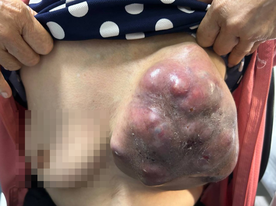 Khối u lớn gây biến dạng hoàn toán vú trái của người phụ nữ