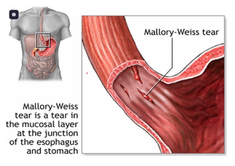 Hội chứng Mallory-Weiss là tình trạng xuất hiện các vết rách dọc ở lớp niêm mạc và dưới niêm mạc (Ảnh minh họa - Nguồn: Internet)