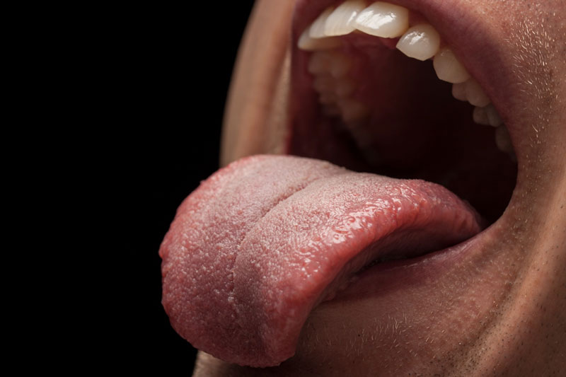Bệnh nấm lưỡi ở người lớn và trẻ em đều do nấm Candida albicans gây ra