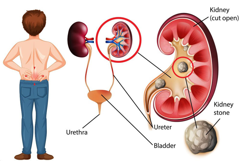 Bệnh gút diễn tiến làm tăng nguy cơ bị sỏi thận