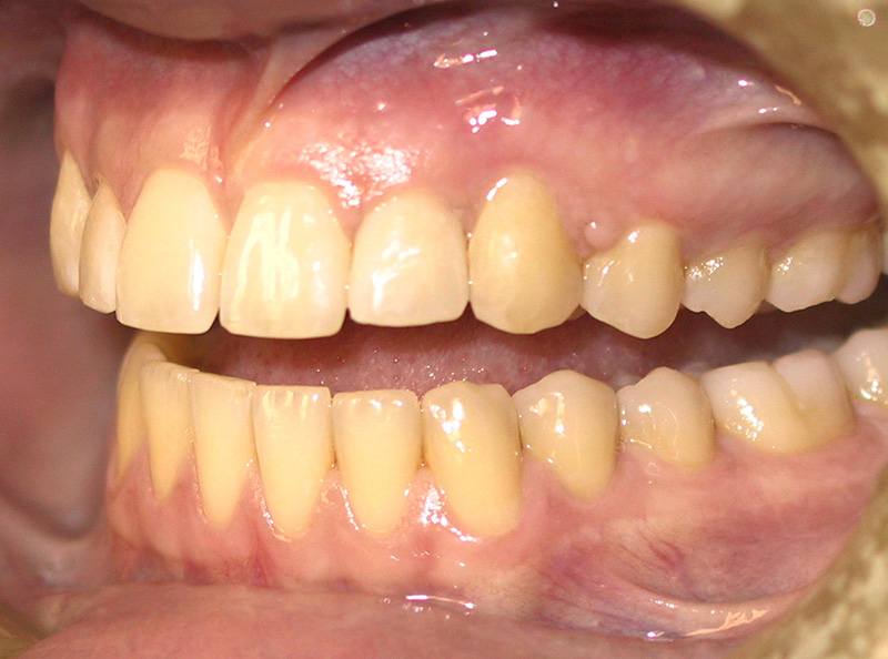  Răng bị vàng phải làm sao 24k - Lựa chọn xu hướng mới cho nụ cười hoàn hảo