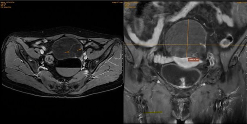 MRI thấy hình ảnh hai khối dạng nang hỗn hợp vị trí buồng trứng trái
