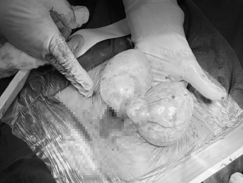 Hình ảnh khối u và buồng trứng trái sau khi phẫu thuật