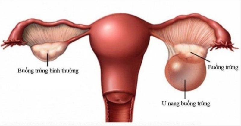 U quái thành thục là loại u tế bào mầm lành tính thường gặp của buồng trứng