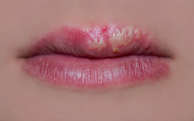 Thuốc Acyclovir được chỉ định điều trị nhiễm virus Herpes simplex (HSV-1 và HSV-2)