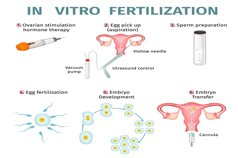Hình ảnh mô phỏng quy trình IVF trong đó có giai đoạn chuyển phôi