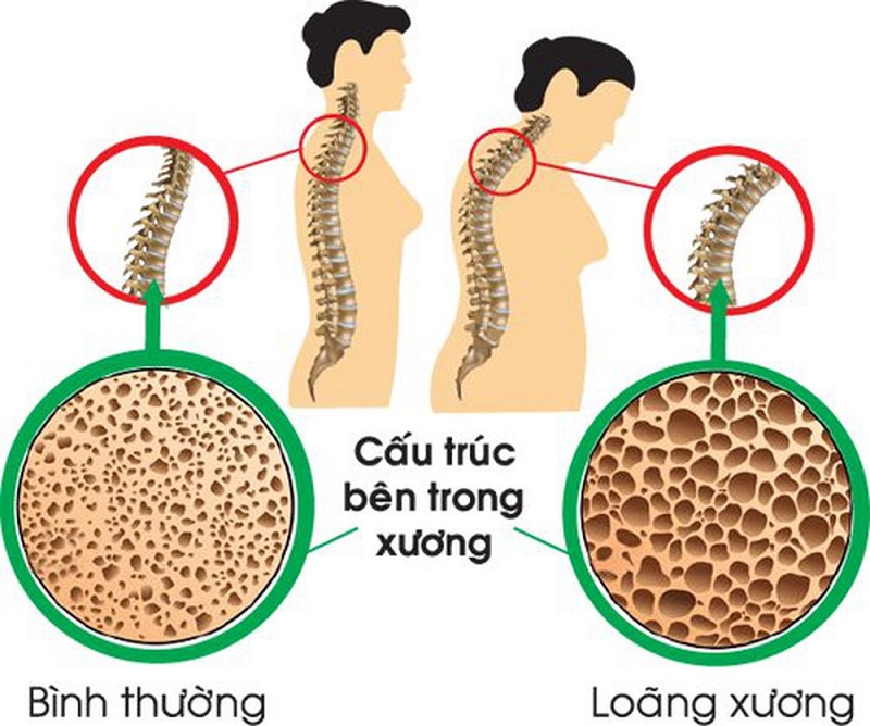 Loãng xương là bệnh lý phổ biến ở phụ nữ sau mãn kinh và người cao tuổi