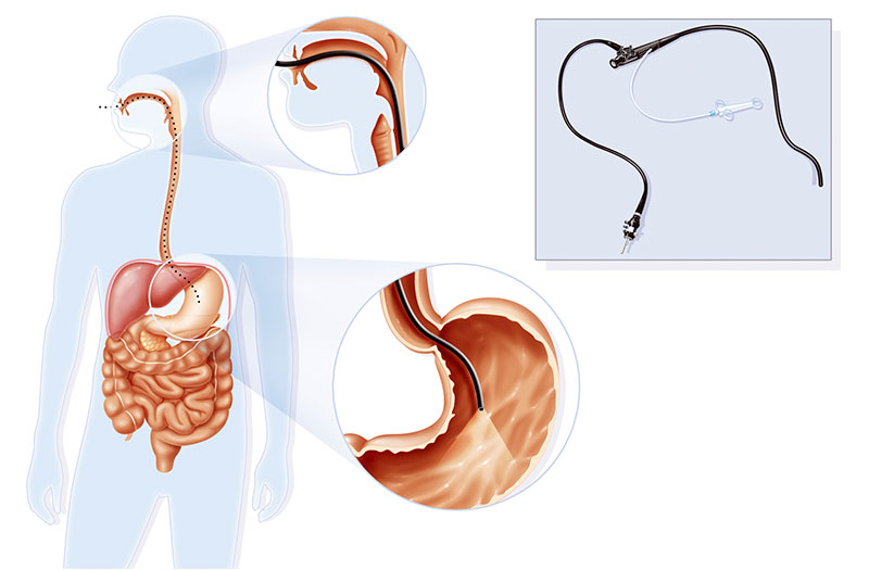 Xét nghiệm trào ngược dạ dày nào là an toàn và chính xác nhất?