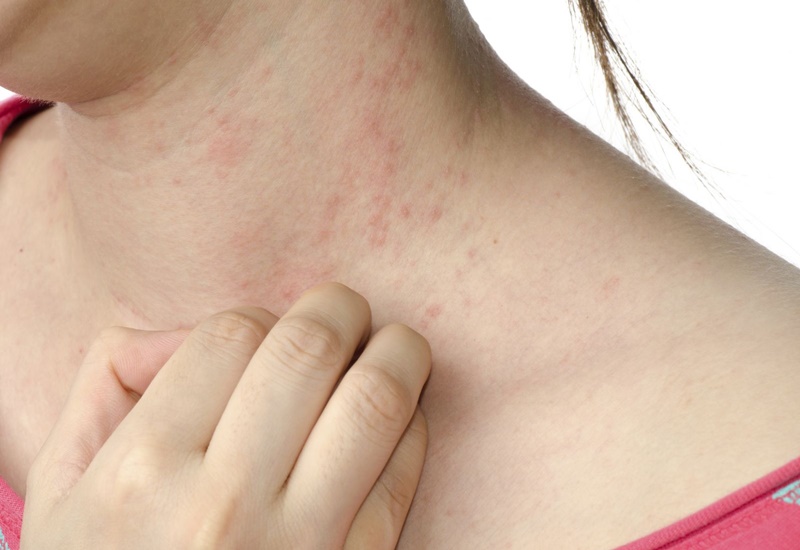 Bạn đã biết ngứa ngoài da là bệnh gì và cách chữa trị chưa?