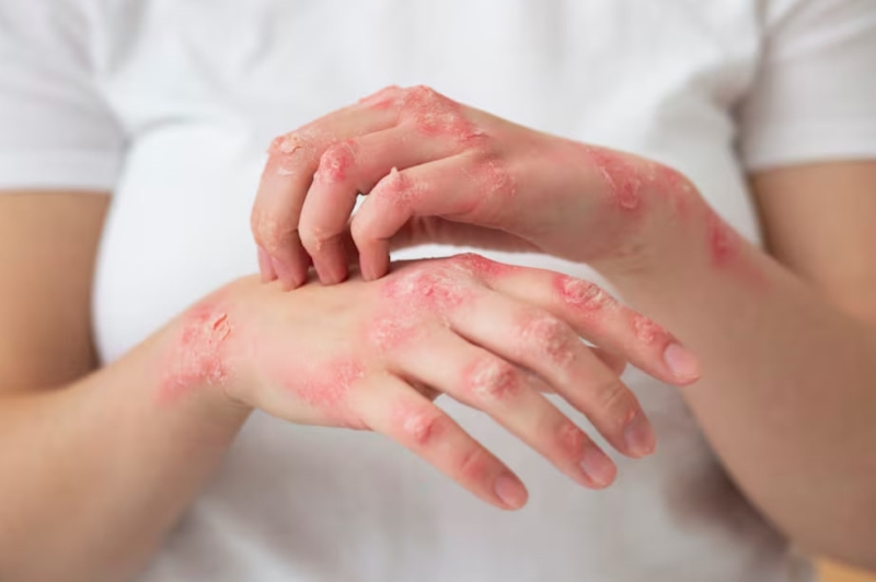 Người dân không nên tự ý dùng cây vòi voi chữa vảy nến