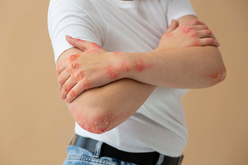 Chàm có mảng da hơi đỏ kèm lớp vảy trắng