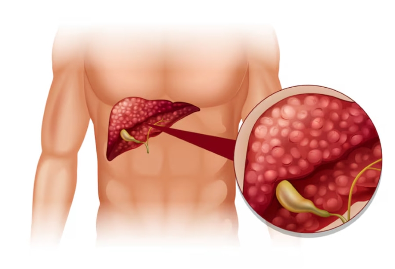 Virus viêm gan B âm thầm gây tổn thương gan 