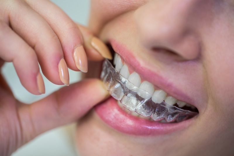 Có nhiều phương pháp niềng răng khác nhau với những ưu, nhược điểm khác nhau