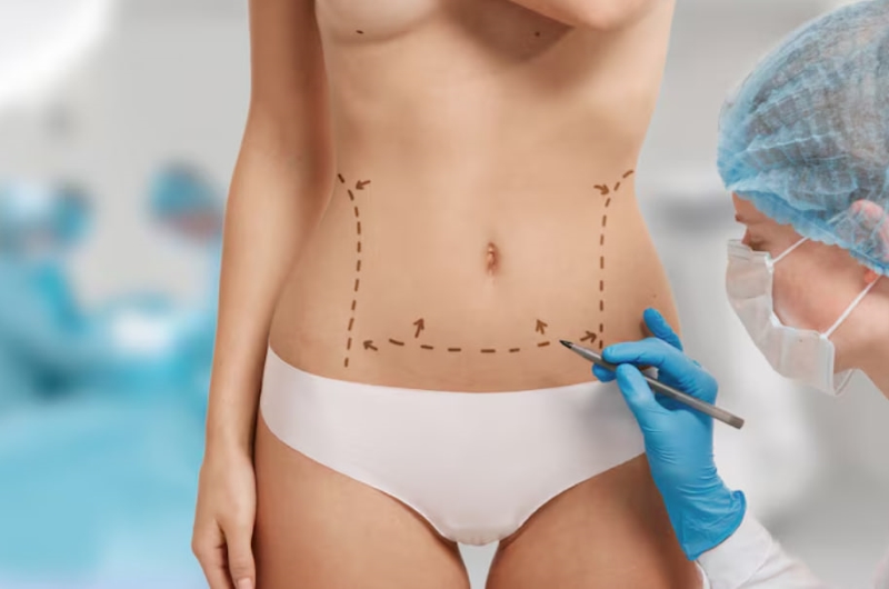 Hút mỡ bụng không phẫu thuật bao gồm nhiều phương pháp thực hiện khác nhau