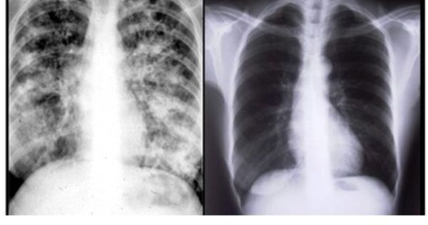 Tình trạng hình ảnh x quang ung thư phổi : Tầm quan trọng và những căn bệnh liên quan